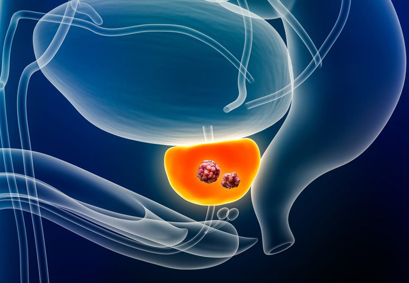 Illustration-of-prostate-cancer